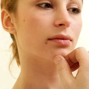 Personas con lunares en Colombia, bajo lupa por posible calvario: aviso entre agosto y octubre