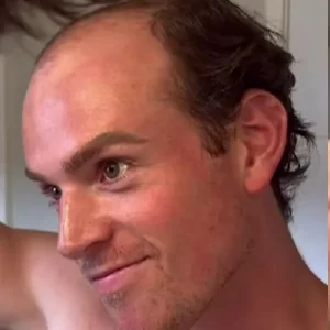 [Video] Joven contó que se quedó calvo a los 26 años: lo reveló en redes y le llovieron reacciones